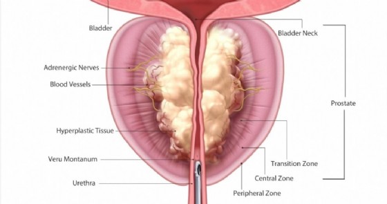 prostata ingrossata intervento