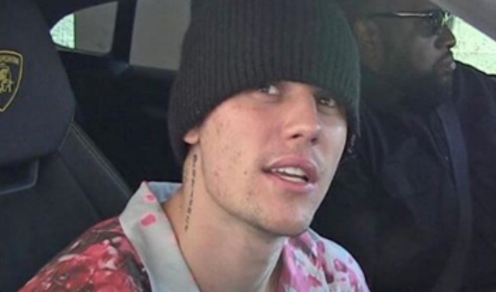 Justin Bieber malattia di Lyme