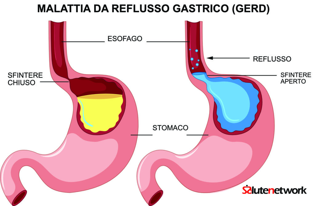 reflusso gastrico